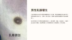 《男性乳腺增生》课件