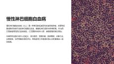 《慢性淋巴细胞白血病》课件