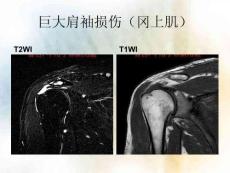 肩关节袖损伤诊疗攻略培训课件