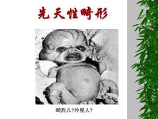 先天性畸形培训课件