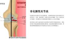 《非化脓性关节炎》课件