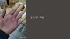 凍傷培訓(xùn)課件