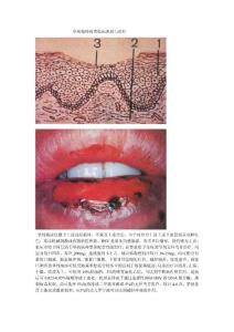 单纯疱疹临床表现与治疗（口腔黏膜病一）