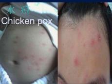 自水痘出疹前1～2天至皮疹干燥结痂时，均有传染性。易感儿童接触带 ...