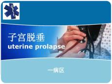 子宫脱垂课件